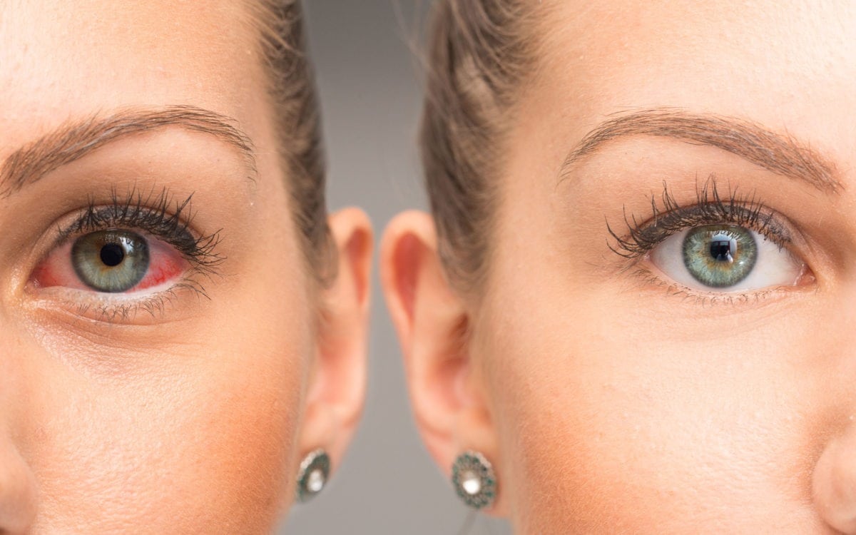 درمان طبیعی خشکی چشم