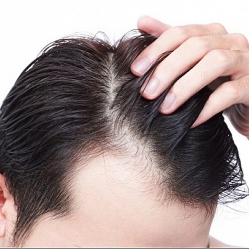 هر آنچه درباره کاشت مو باید بدانید (قسمت اول)